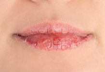 Lèvres gercées : quels remèdes fonctionnent vraiment pour les soigner ? Une femme qui a les lèvres gercées comme chaque hiver.
