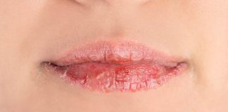 Lèvres gercées : quels remèdes fonctionnent vraiment pour les soigner ? Une femme qui a les lèvres gercées comme chaque hiver.