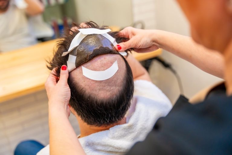Un jeune qui a recours à une prothèse capillaire pour masquer sa calvitie.