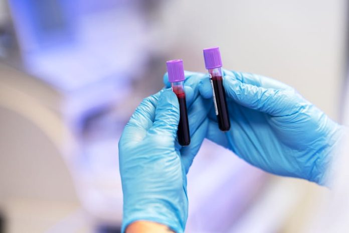 Covid prise de sang pour repérer les patients les plus à risque Ma Santé Un médecin réalise une prise de sang chez un patient atteint de Covid-19 afin d’évaluer son risque de développer une forme grave.
