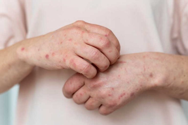 Une femme présentant une éruption cutanée liée au virus Mpox.