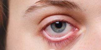 Å’il rouge d’Emmanuel Macron : quelles sont les causes possibles ? Présentation d'un oeil rouge comme le président Macron.