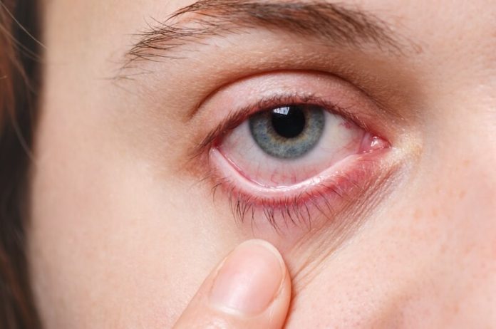 OEil-rouge-causes-president-Macron-souffrir-traitement-Ma-Sante Présentation d'un oeil rouge comme le président Macron.