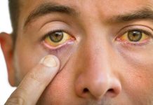 Pourquoi les yeux qui jaunissent ne sont pas synonymes de cancer du pancréas ? Un homme remarque que le blanc de ses yeux jaunit et redoute qu’il s’agisse d’un cancer du pancréas.