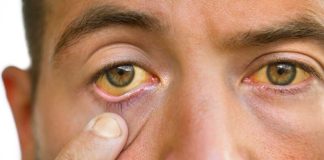 Pourquoi les yeux qui jaunissent ne sont pas synonymes de cancer du pancréas ? Un homme remarque que le blanc de ses yeux jaunit et redoute qu’il s’agisse d’un cancer du pancréas.