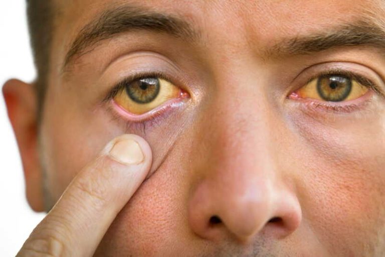 Un homme remarque que le blanc de ses yeux jaunit et redoute qu’il s’agisse d’un cancer du pancréas.