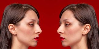 Isotrétinoïne : cette nouvelle tendance TikTok promet… un nez plus affiné ! Une femme pense avoir le nez plus fin après avoir été traitée avec Roaccutane.