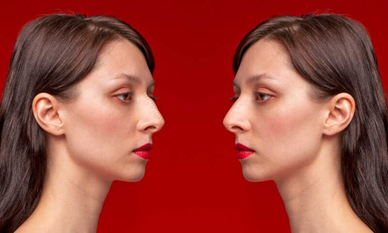 Une femme pense avoir le nez plus fin après avoir été traitée avec Roaccutane.