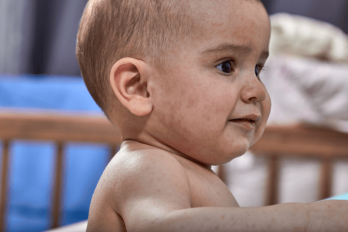 Roséole symptômes causes traitements solution ma sante Un nourrisson présentant des taches rosées sur le visage, ressemblant à une roséole.