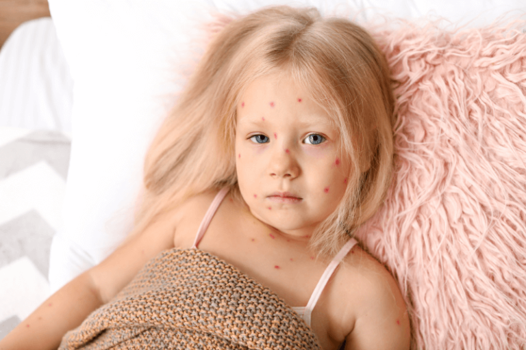 Une petite fille avec des boutons rouges sur le visage suspectant une varicelle