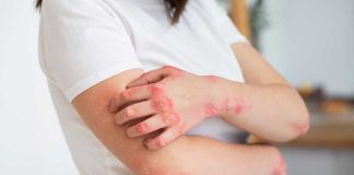 Eczéma : comment le stress aggrave-t-il les symptômes cutanés ? Une femme qui souffre de poussées d’eczéma liées au stress.