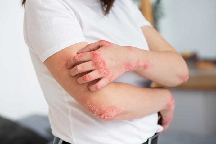 Eczéma comment le stress aggrave les symptômes cutanés Ma Santé Une femme qui souffre de poussées d’eczéma liées au stress.