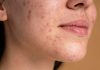 Acné, règles, fatigue : quels sont les signes de la puberté chez les adоlescents ? Une adolescente qui voit apparaître des changements sur sa peau, avec de l’acné, des symptômes de la puberté.