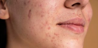 Acné, règles, fatigue : quels sont les signes de la puberté chez les adоlescents ? Une adolescente qui voit apparaître des changements sur sa peau, avec de l’acné, des symptômes de la puberté.