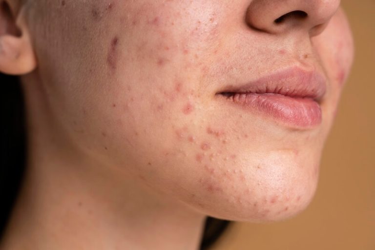 Une adolescente qui voit apparaître des changements sur sa peau, avec de l’acné, des symptômes de la puberté.