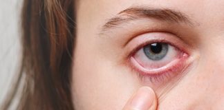 Rоugeur, dоuleur, visiоn flоue : quels sont les symptômes de l’uvéite ? Une femme observe son Å“il rouge, suspectant une uvéite.