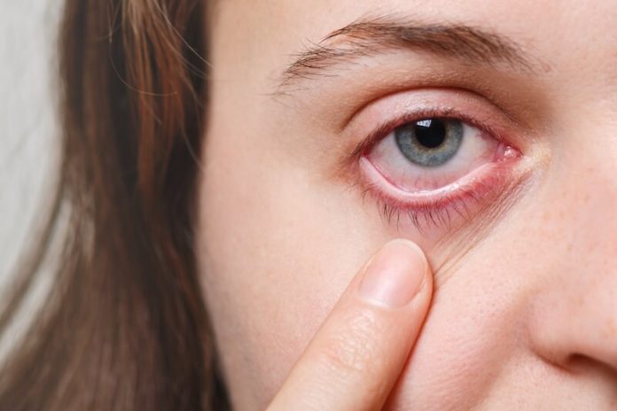uévite imflamation oeil symptômes causes traitements ma sante cécité catarate ophtalmologie ma santre Une femme observe son œil rouge, suspectant une uvéite.