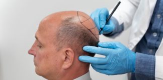 Calvitie : la greffe de cheveux est-elle une solution fiable et efficace ? Praticien réalisant un marquage du cuir chevelu avant une greffe capillaire chez un homme atteint d’alopécie androgénétique.