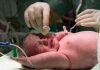 Un bébé né par césarienne avec des déséquilibres du microbiote intestinal.