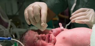 Naître par césarienne : un impact durable sur le microbiote et la santé intestinale ? Un bébé né par césarienne avec des déséquilibres du microbiote intestinal.
