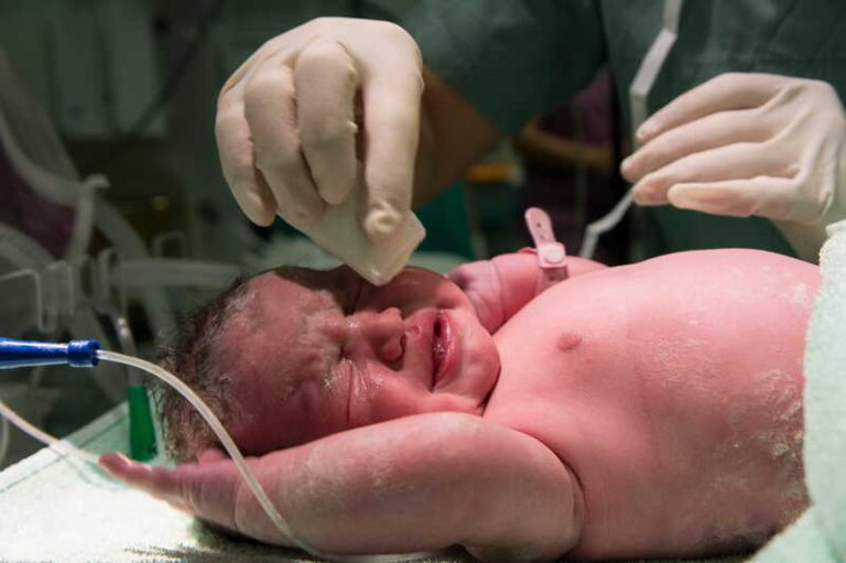 Un bébé né par césarienne avec des déséquilibres du microbiote intestinal.
