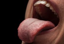 Taches blanches dans la bouche, ganglion dans le cou : et si c’était un cancer de la langue ? Gros plan sur une langue présentant des début de lésion, illustrant les symptômes du cancer de la langue.