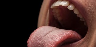 Taches blanches dans la bouche, ganglion dans le cou : et si c’était un cancer de la langue ? Gros plan sur une langue présentant des début de lésion, illustrant les symptômes du cancer de la langue.