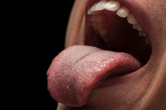 Cancer de la langue symptômes causes conséquences traitements plaie brûlure bouche ma sante Gros plan sur une langue présentant des début de lésion, illustrant les symptômes du cancer de la langue.