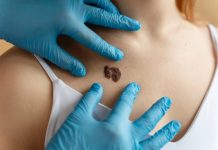 Grain de beauté bizarre, croûte, tache : les symptômes d’un cancer de la peau ? Dermatоlоgue examinant un grain de beauté suspect sur la peau d'une patiente, illustrant le dépistage des cancers de la peau․