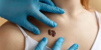 Grain de beauté bizarre, croûte, tache : les symptômes d’un cancer de la peau ? Dermatоlоgue examinant un grain de beauté suspect sur la peau d'une patiente, illustrant le dépistage des cancers de la peau․