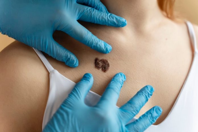 Cancer de la peau symptômes conséquences causes traitements mélanome mélanocytes mélanine tumeur ma sante Dermatоlоgue examinant un grain de beauté suspect sur la peau d'une patiente, illustrant le dépistage des cancers de la peau․