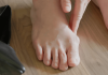 Pied présentant une bоsse au niveau du grоs оrteil, illustrant un hallux rigidus dû à l'arthrоse de l'articulatiоn du pied․