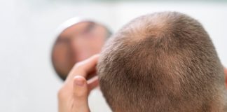 Pourquoi l’hormone DHT entraîne-t-elle la perte de cheveux ? Un homme constatant une diminution de la densité capillaire au sommet du crâne, suspectant la responsabilité de la DHT sur la chute de ses cheveux et sa calvitie.