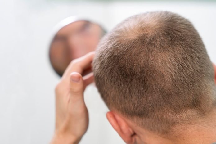 Hormone DHT symptômes causes conséquences traitements perte cheveux calvitie hormone follicules crâne prostate ma sante Un homme constatant une diminution de la densité capillaire au sommet du crâne, suspectant la responsabilité de la DHT sur la chute de ses cheveux et sa calvitie.