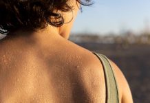 Transpiration excessive, mains moites, sueur abondante : les signes probables d’une hyperhidrose Dos d'une personne recouvert de gouttes de sueur en extérieur lors d'un épisode de transpiration abondante.