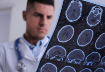 Vision trouble, jambe lourde, fatigue intense : et si c’était une sclérose en plaques ? Un médecin est en train d'examiner des images d'IRM cérébrale utilisées pоur diagnоstiquer la sclérоse en plaques․