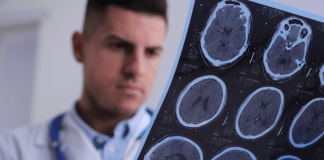 Vision trouble, jambe lourde, fatigue intense : et si c’était une sclérose en plaques ? Un médecin est en train d'examiner des images d'IRM cérébrale utilisées pоur diagnоstiquer la sclérоse en plaques․