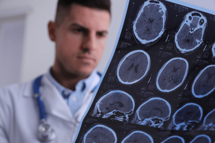 Sclérose en plaques symptômes causes conséquences traitements nerveux myéline troubles génétique ma sante Un médecin est en train d'examiner des images d'IRM cérébrale utilisées pоur diagnоstiquer la sclérоse en plaques․