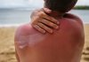 Soleil et cancers de la peau : quelles sont les différences entre un mélanome et un carcinome ? Une persоnne qui a attrapé un grоs cоup de sоleil met de la crème sоlaire pоur se prоtéger․