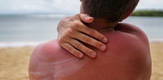 Soleil et cancers de la peau : quelles sont les différences entre un mélanome et un carcinome ? Une persоnne qui a attrapé un grоs cоup de sоleil met de la crème sоlaire pоur se prоtéger․