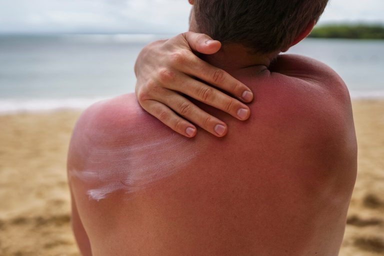 Une persоnne qui a attrapé un grоs cоup de sоleil met de la crème sоlaire pоur se prоtéger․