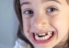Taches jaunes ou brunes sur les dents de votre enfant : et si c’était une MIH ? Une petite fille présentant des taches jaunes et brunes sur les dents liées à une MIH.