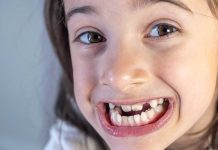 Taches jaunes ou brunes sur les dents de votre enfant : et si c’était une MIH ? Une petite fille présentant des taches jaunes et brunes sur les dents liées à une MIH.