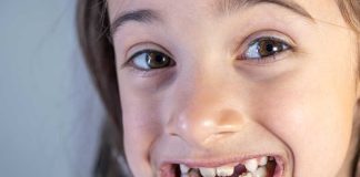 Taches jaunes ou brunes sur les dents de votre enfant : et si c’était une MIH ? Une petite fille présentant des taches jaunes et brunes sur les dents liées à une MIH.