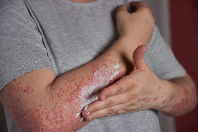 Une personne atteinte de psoriasis sévère qui applique un traitement à base de crème.