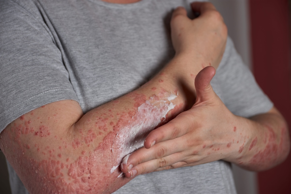 Une personne atteinte de psoriasis sévère qui applique un traitement à base de crème.