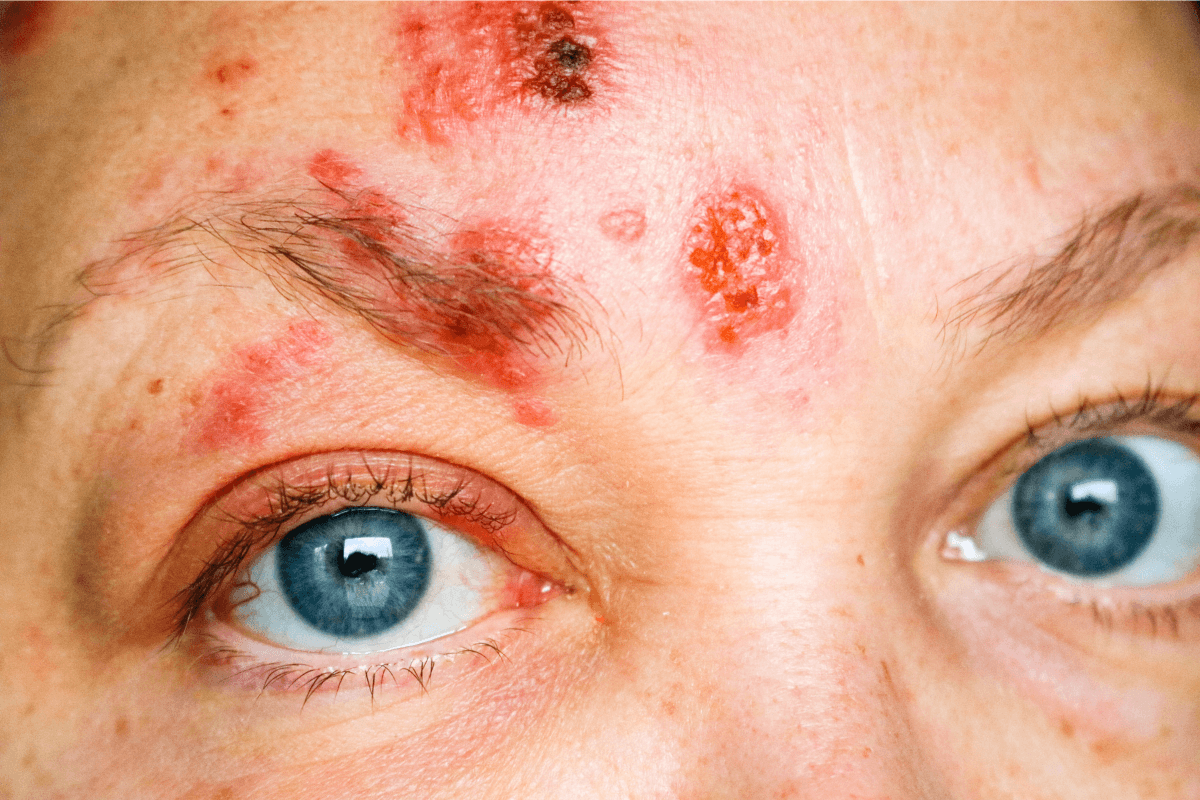 Éruption de boutons rouges et de croûtes sur le front, au-dessus de l'œil, suspectant un zona ophtalmique.