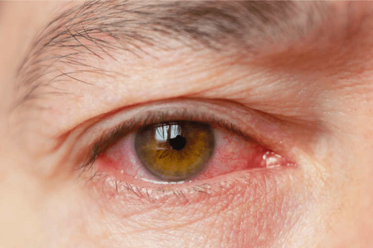 Œil rouge et irrité, symptôme d'une kératoconjonctivite.
