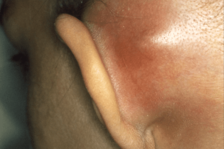 Gonflement rouge derrière l'oreille chez un enfant atteint d'une mastoïdite.