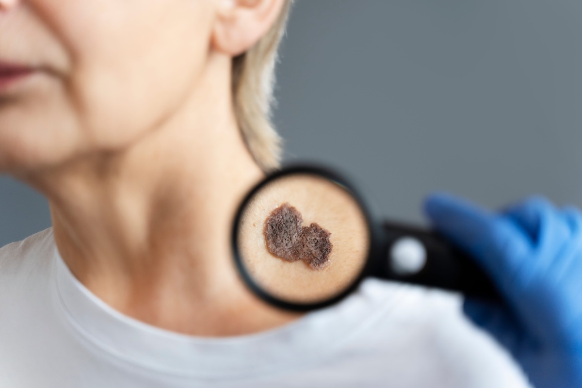 Une femme qui fait examiner un grain de beauté inquiétant par un dermatologue.